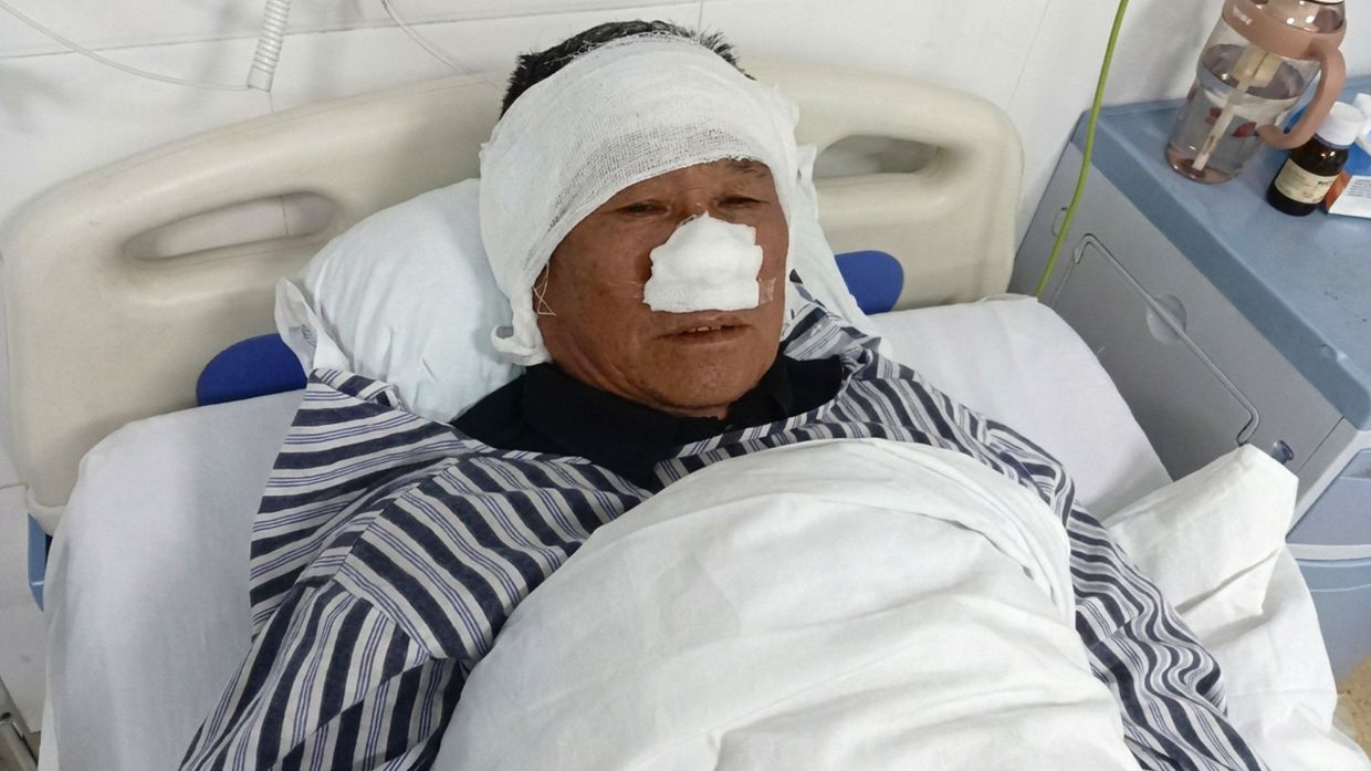 Chinese villager loses nose saving woman from attacker, honoured as national hero