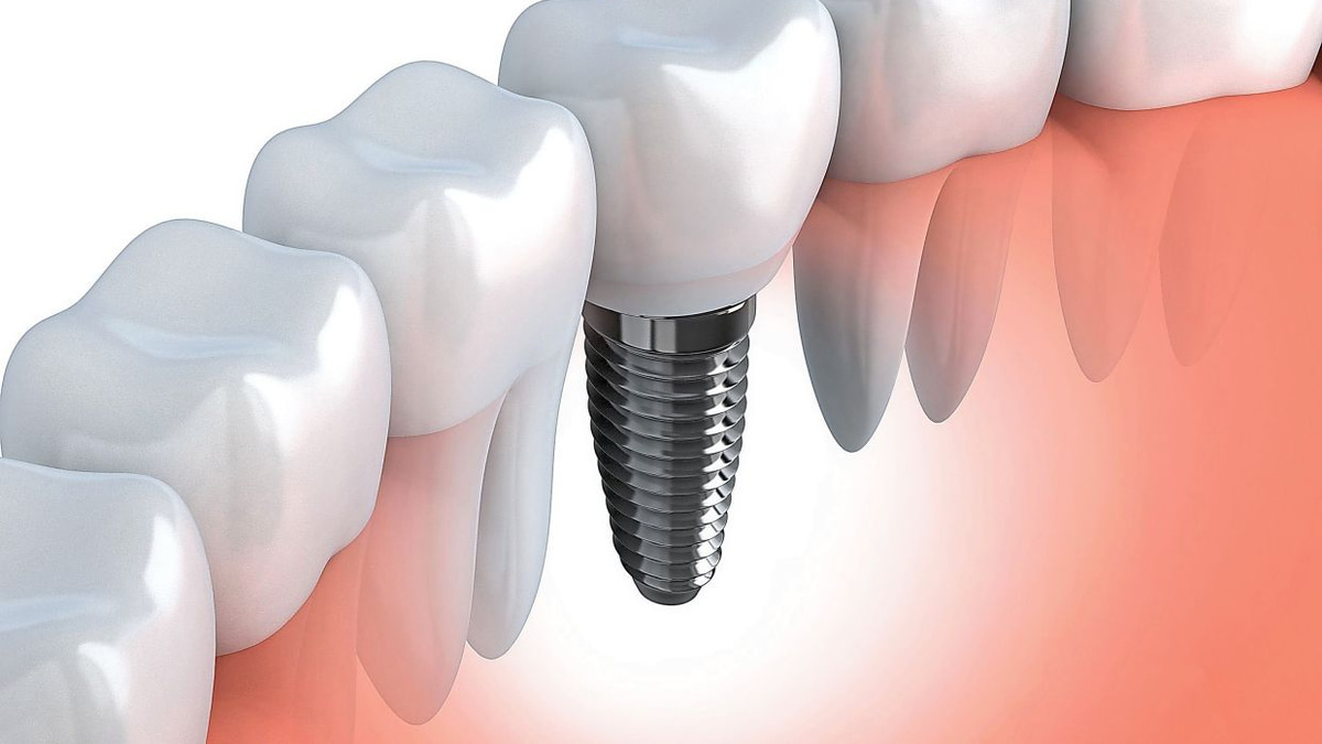 Guarding Against Peri-Implantitis: Why Dental Implant Care Requires Vigilance
