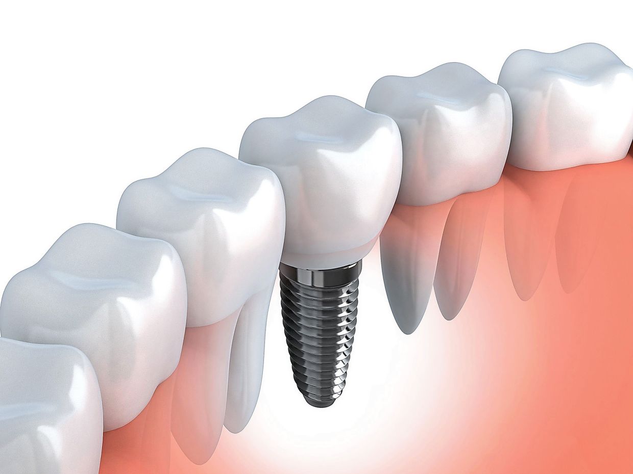 Guarding Against Peri-Implantitis: Why Dental Implant Care Requires Vigilance