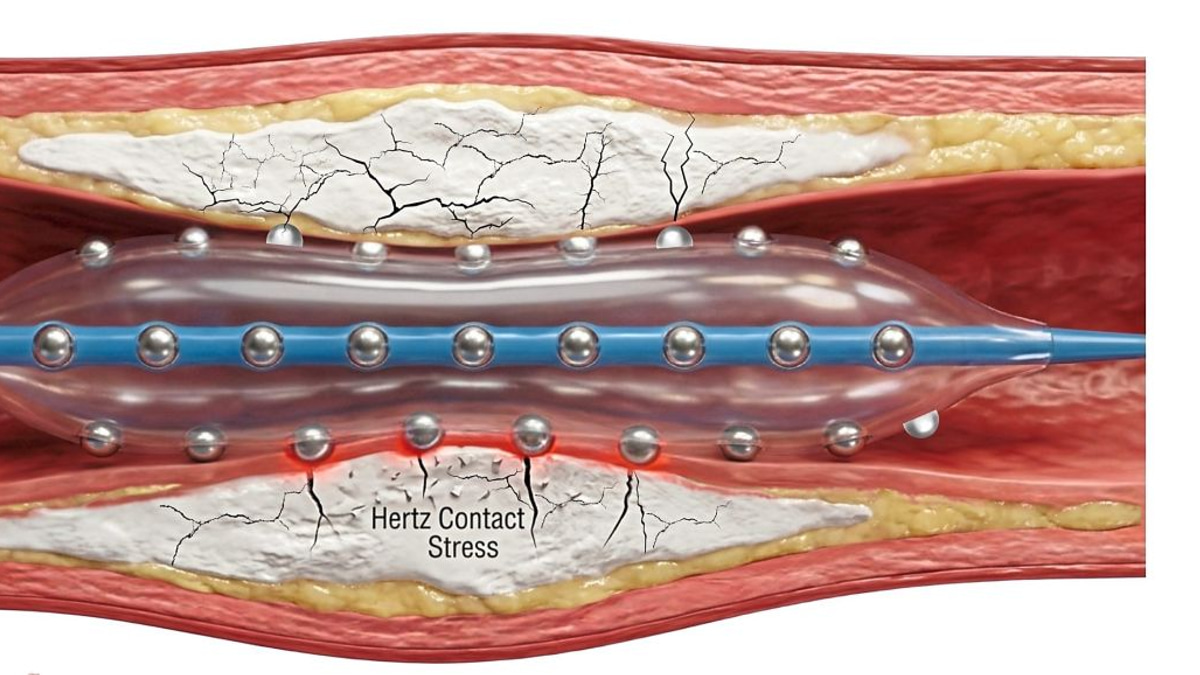 Malaysian cardiologists pioneer advanced technique to treat hardened heart artery blockages