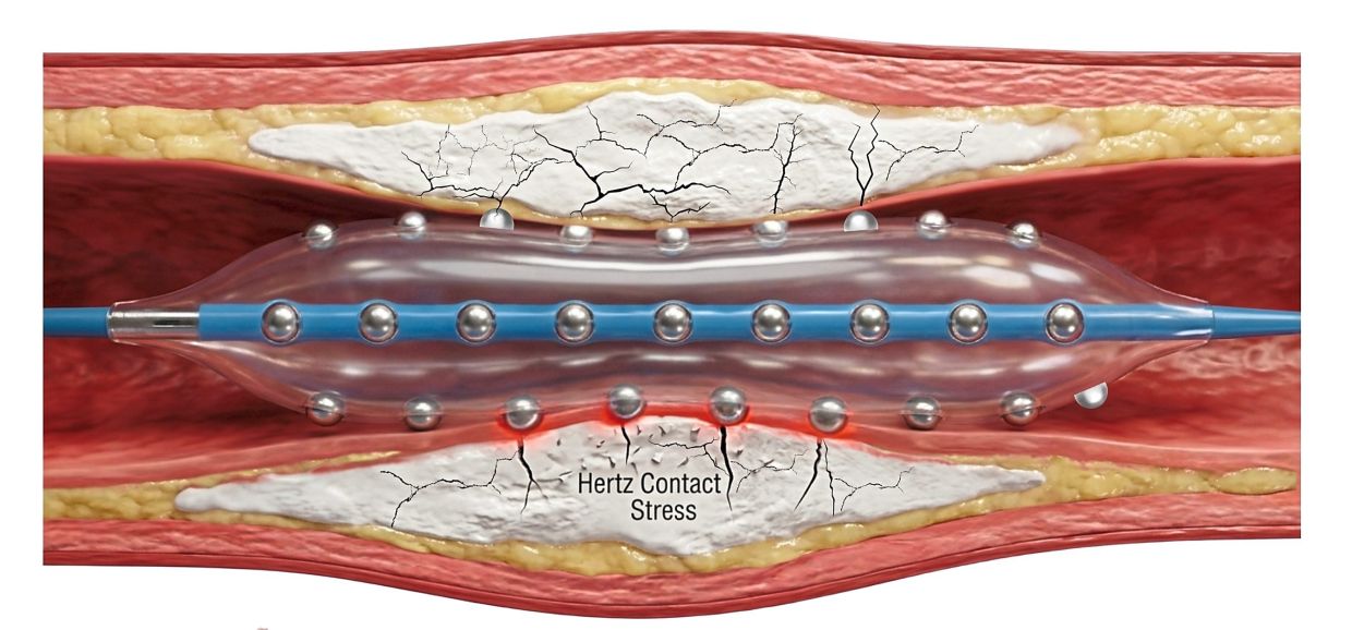 Malaysian cardiologists pioneer advanced technique to treat hardened heart artery blockages